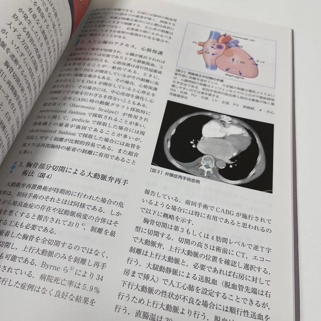 弁膜症外科の要点と盲点