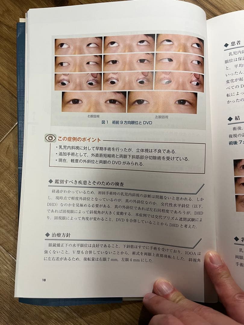 斜視治療のストラテジー